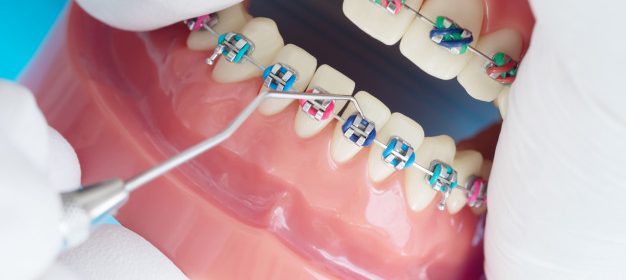 Braces in orthodontic treatment