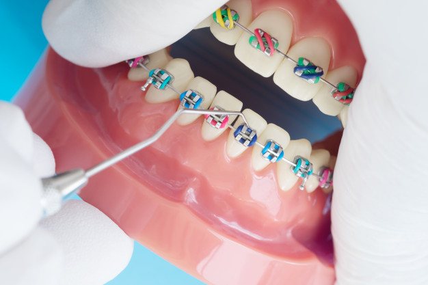 Braces in orthodontic treatment
