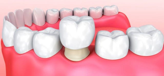 coronas dentales