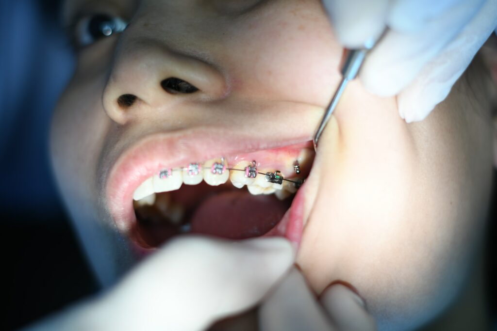 Brackets metálicos: cómo elegir los mejores para tu clínica dental