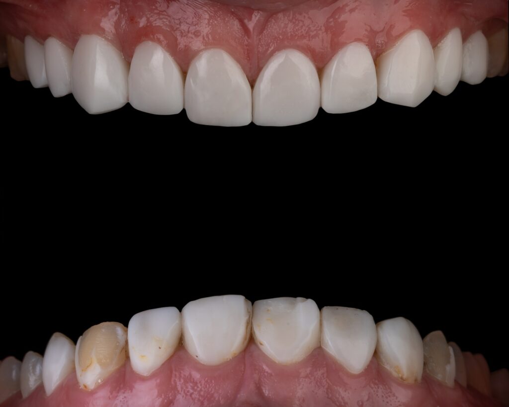 Composites dentales: qué son y se utilizan en la odontología