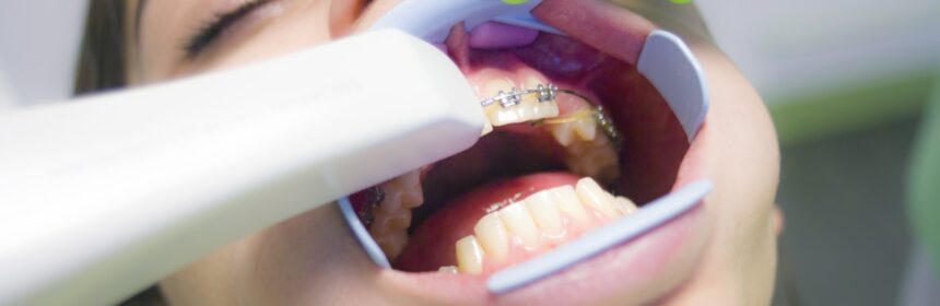 Brackets metálicos: cómo elegir los mejores para tu clínica dental elegir los mejores brackets metálicos para tu clínica dental metálicos